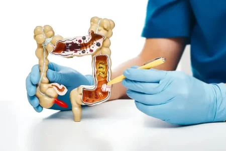 بررسی علائم، دلایل، تشخیص و درمان پولیپ روده چیست؟